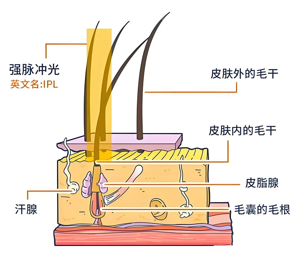 濾光片 光子脫毛